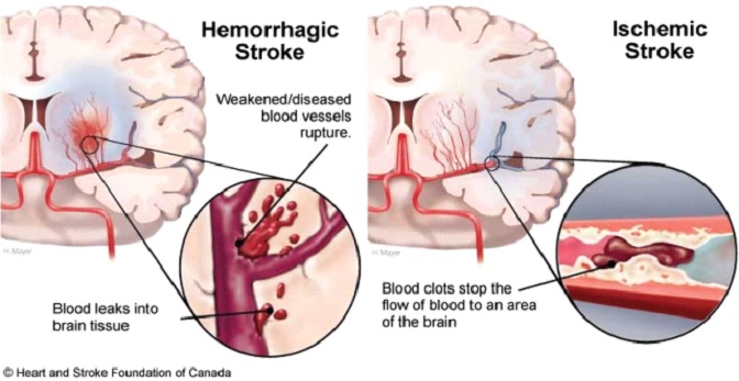 vérzéses stroke és magas vérnyomás